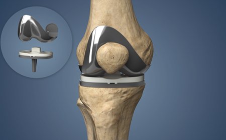 Expert Advice: When to See a Joint Replacement Surgeon in Jaipur