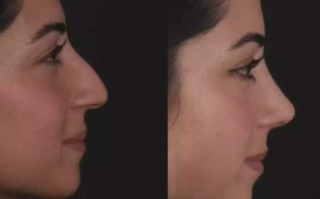 Best Septoplasty Surgeon in Dubai for Nose Blockage