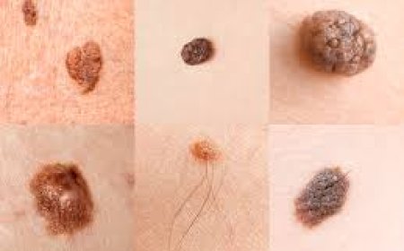 Top Sun Protection Habits to Prevent Skin Cancer