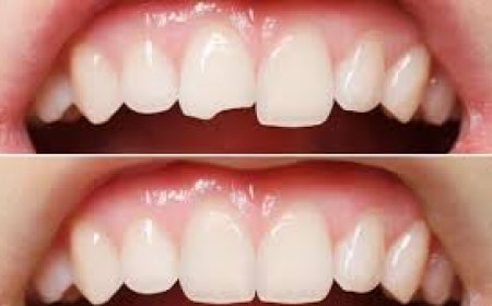 How Emergency Dentists Treat Broken or Cracked Teeth Quickly