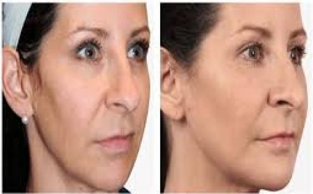 Non-surgical face lift Bangalore treatments that work without surgery