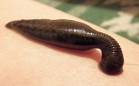 Leech Therapy in Mumbai for Plastic Surgery Recovery