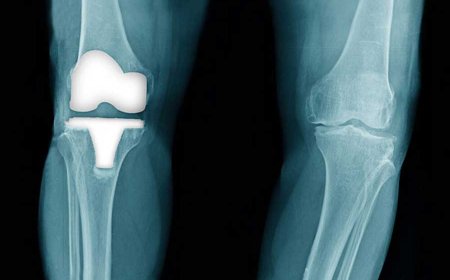 How to Avoid Knee Replacement: Early Treatments & Lifestyle Tips