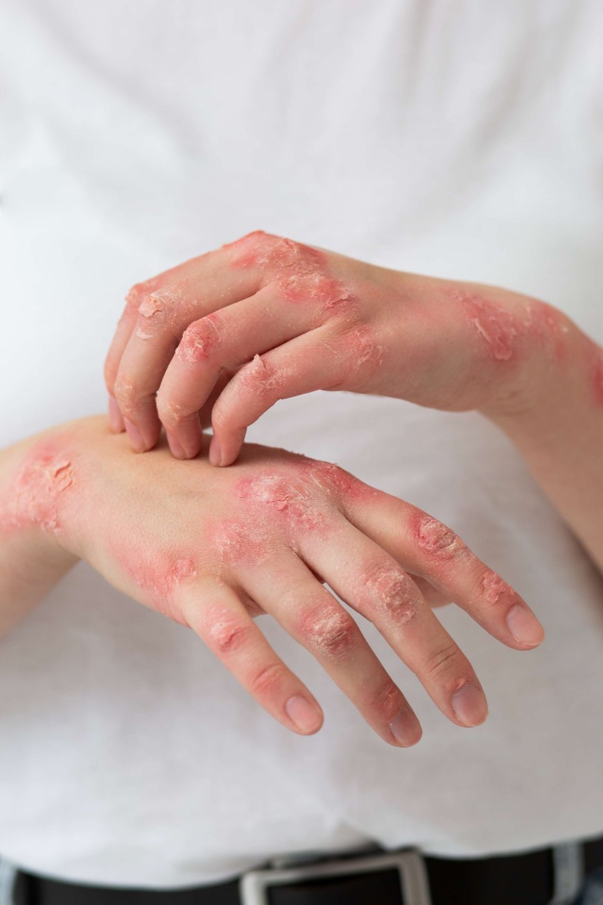 Ivercor 12 mg Tablet Benefits – More Than Just Parasite Treatment