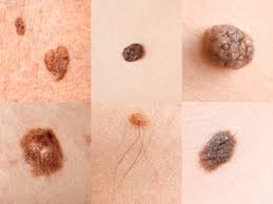 Top Sun Protection Habits to Prevent Skin Cancer