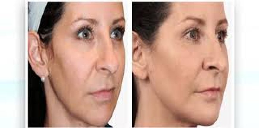 Non-surgical face lift Bangalore treatments that work without surgery