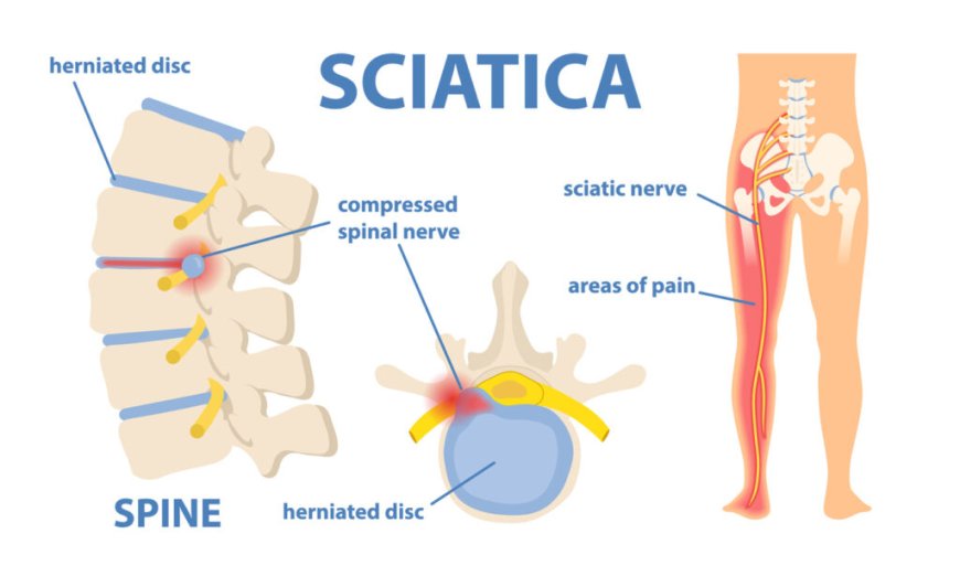 Understanding Sciatica and How Aspadol Might Help
