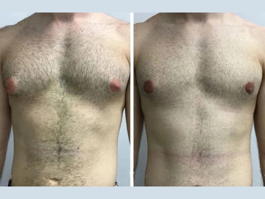 Gynecomastia Surgery in Dubai for Teenagers: Is It Recommended?