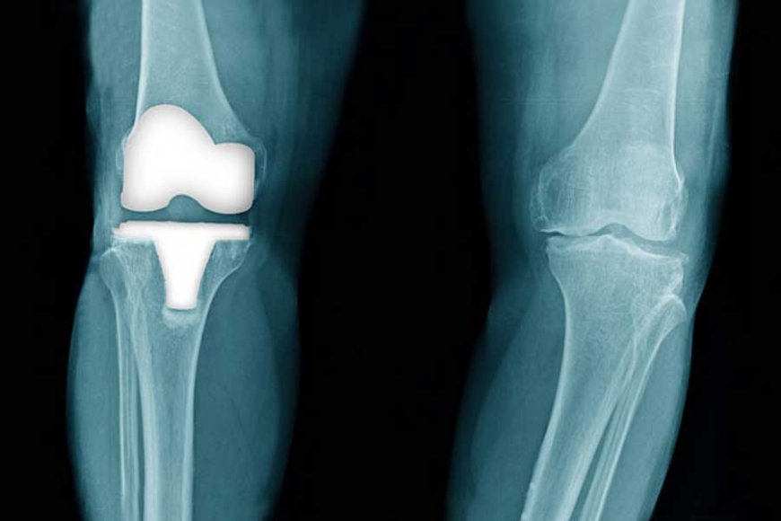 How to Avoid Knee Replacement: Early Treatments & Lifestyle Tips